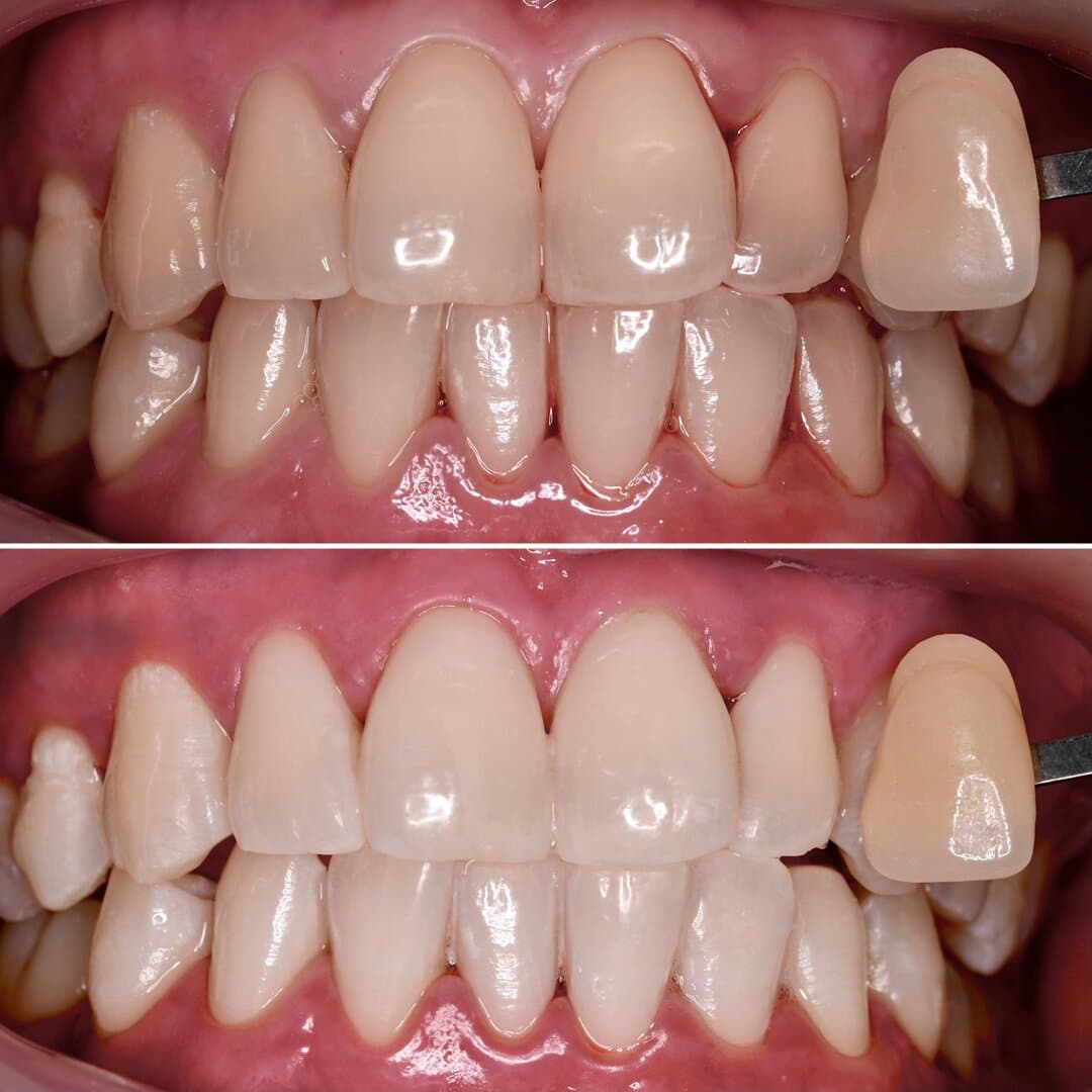 Teeth Whitening β before and after