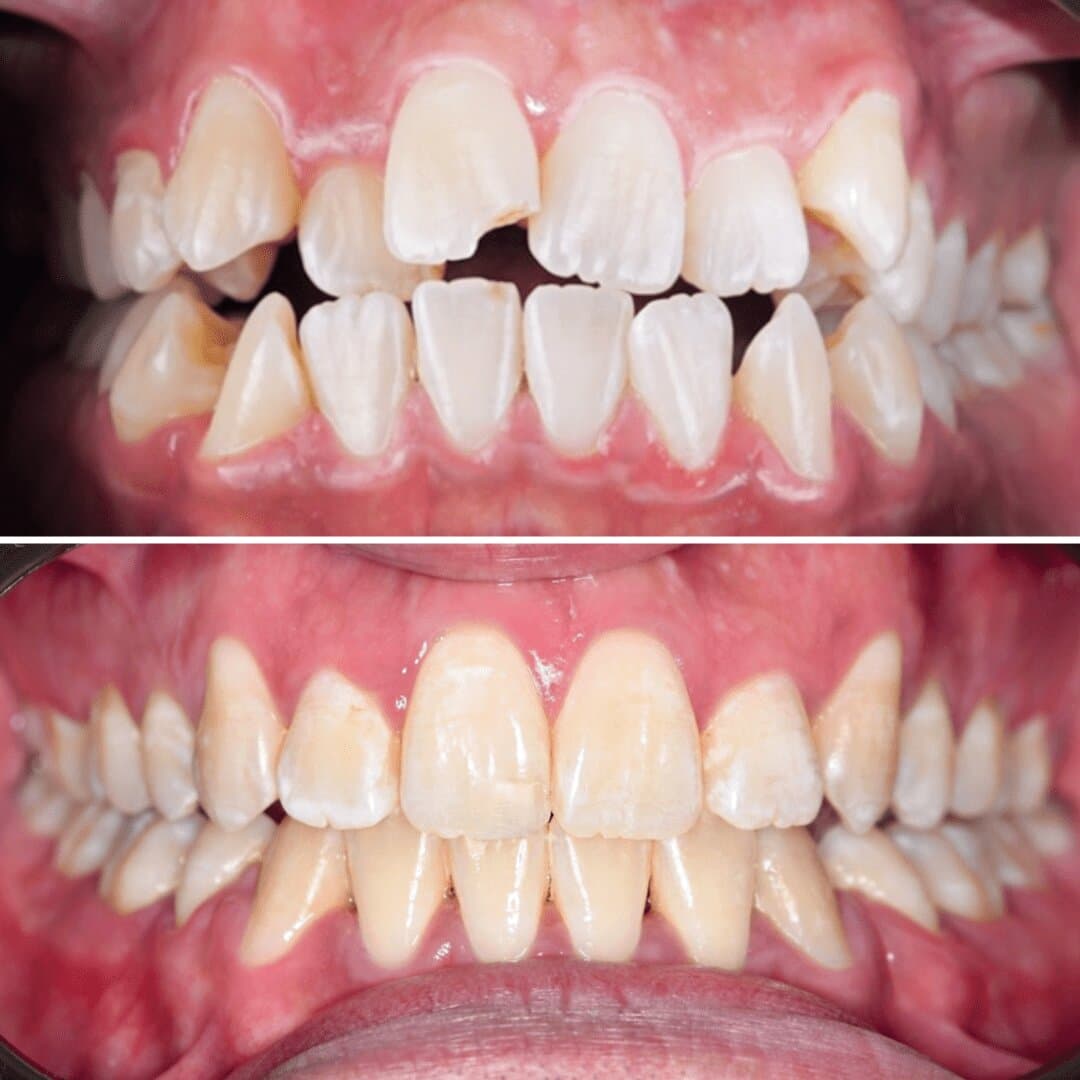 Before & After Braces β before and after